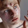 Co zaostrza trądzik i jak tego unikać?