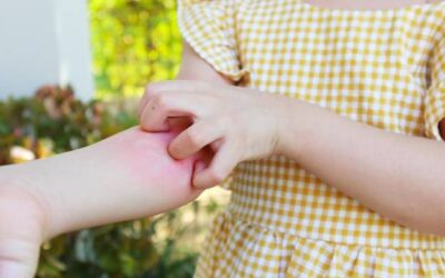 Atopowe zapalenie skóry u dzieci czym leczyć w domu?