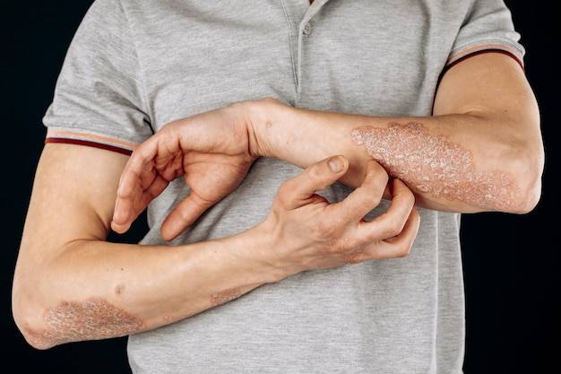 Uczulenie na nikiel czego unikać w codziennym życiu?